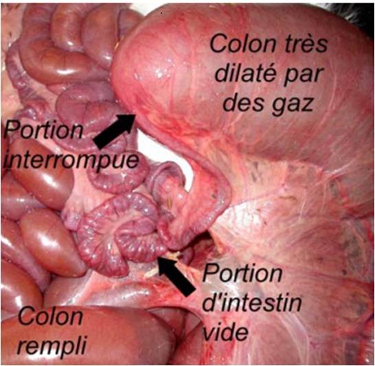 atrésie du colon