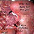 atrésie du colon